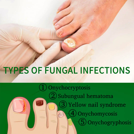 Healthy nails after treatment