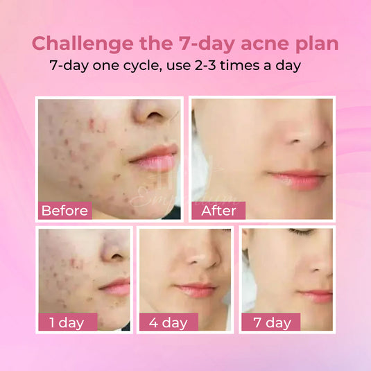 Pore-clearing acne solution