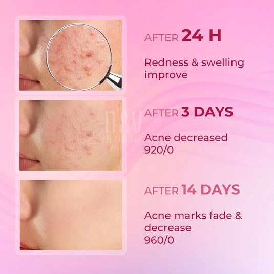 Redness-reducing acne cream