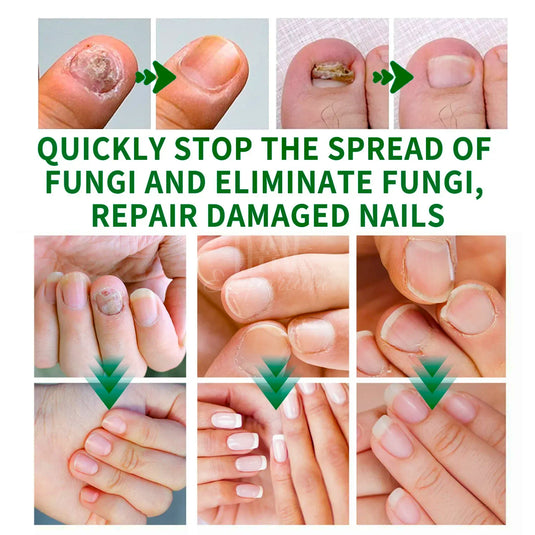 Deep-penetrating nail fungus remedy