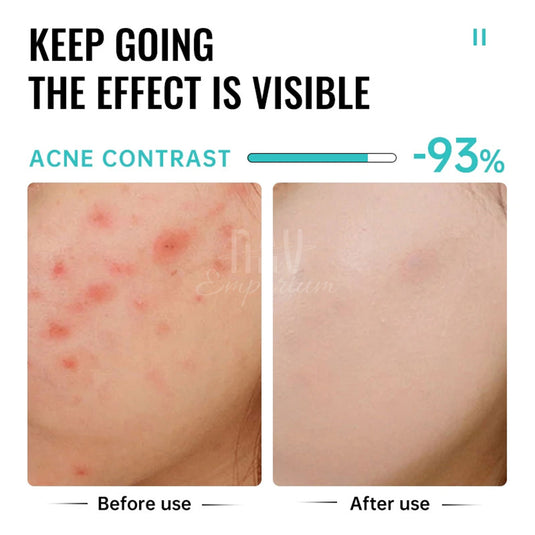 Fast-absorbing acne treatment