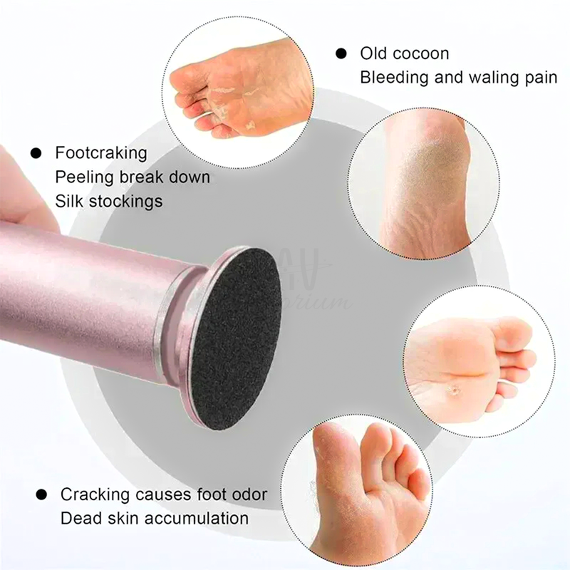 Cracked Heel Treatment