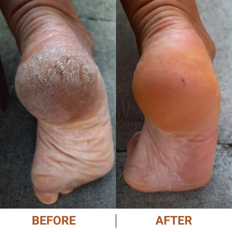 Gentle Foot Exfoliator