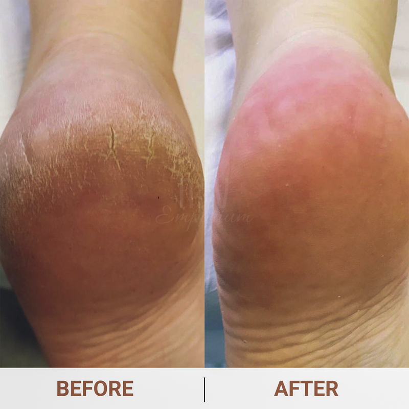 Dry Skin Remover