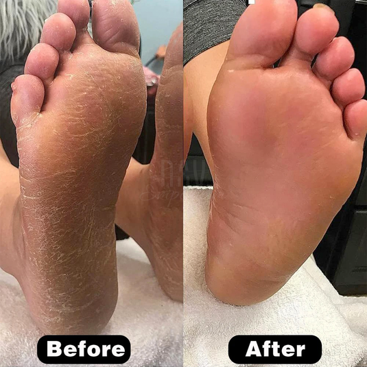 Soft Feet Solution