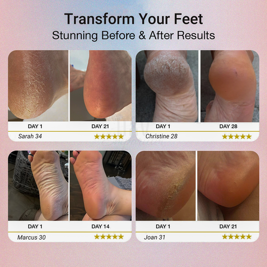 Foot Callus Remover